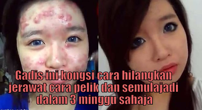 Cara Menghilangkan Jerawat Di Wajah dan Badan Dengan Cepat Dan Semulajadi